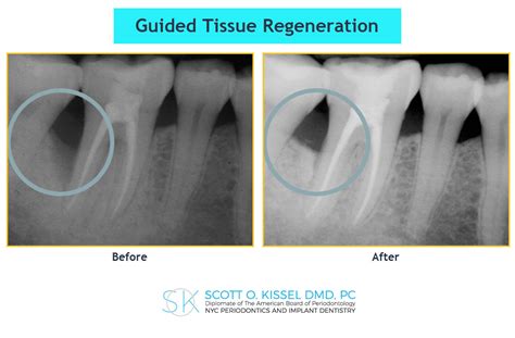 guided tissue regeneration las vegas nv